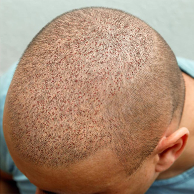 FUE hair transplant after Surgery
