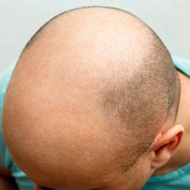 FUE hair transplant before Surgery