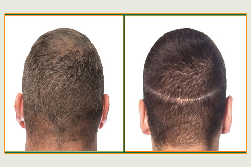 WHAT IS FUT HAIR TRANSPLANT?