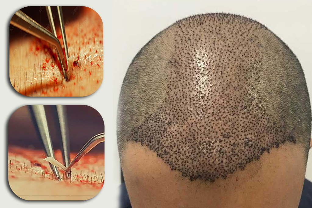 SHI Hair Transplant Clinic in Hanamkonda