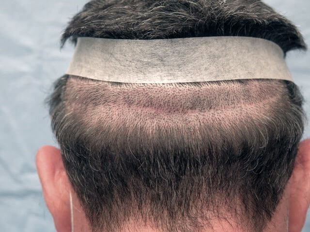 Doner area in Hair transplant